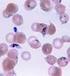 Plasmodium vivax: causa de malária grave