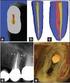 COMPARATIVE ANALYSIS OF ROOT CANAL ANATOMY AFTER MECHANICAL PREPARATION WITH HYFLEX CM AND HYFLEX EDM