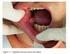 Prevalência das Lesões de Tecidos Moles Causadas por Próteses Removíveis nos Pacientes da Faculdade de Odontologia de Caruaru, PE, Brasil