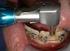 Torque de inserção e remoção de mini-implantes ortodônticos em diferentes espessuras de cortical