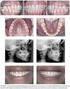 TERAPIA POR AJUSTE OCLUSAL