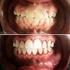 Tracionamento ortodôntico: possíveis consequências nos caninos superiores e dentes adjacentes