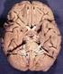 18. É o par de nervo craniano responsável pela inervação sensitiva, inclusive gustativa do terço posterior da língua: a) IV b) V c) VII d) IX e) X