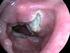 I ntroduction: Laryngeal symptoms from the