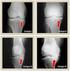 Fadiga óssea: causa de dor em joelhos na osteoartrite *