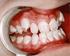 Prevalence and severity of dental fluorosis among students from João Pessoa, PB, Brazil