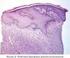 Histiocitomas fibrosos: revisão histopatológica de 95 casos
