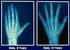 Evaluation and development of a bone age assessment method in patients with Down syndrome