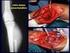 Otratamento não operatório (TNO) de lesão de órgão