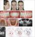 Cephalometric Avaliations of the Lower Anterior Facial Heigth