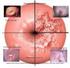 Estadiamento do Carcinoma do Colo do Útero por Ressonância Magnética Comparação com os Achados Anátomo-Patológicos