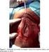 Resumo. 1 Introdução. Palavras chave: Neoplasia intraepitelial cervical. Colo do útero. Recidiva.