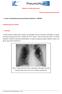 Nódulos e massas pulmonares