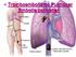 Tromboembolismo Pulmonar Embolia pulmonar